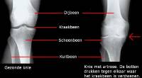 rontgenfoto knie artrose